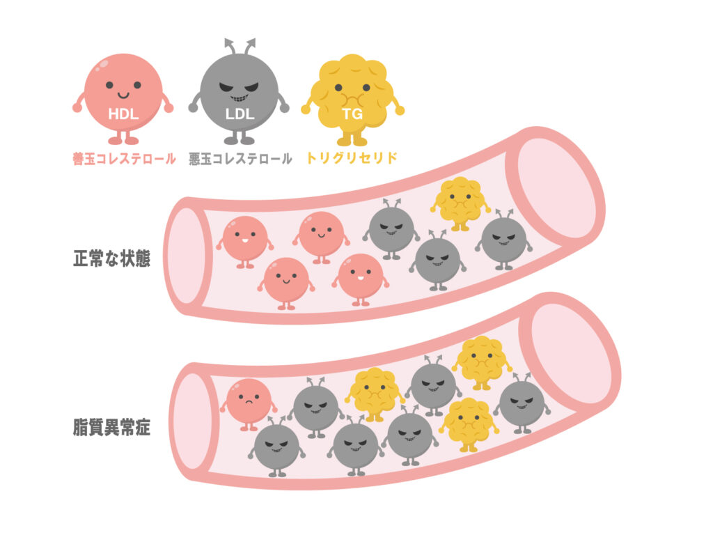 脂質異常症とは